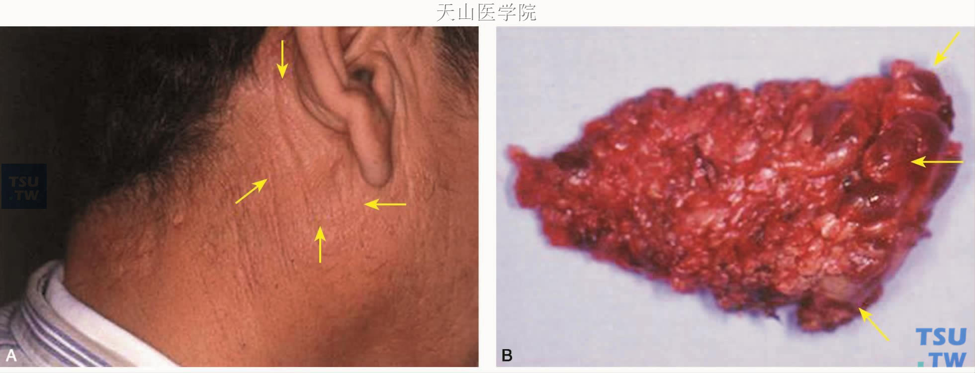 嗜酸性粒细胞增生性淋巴肉芽肿（Kimura病）