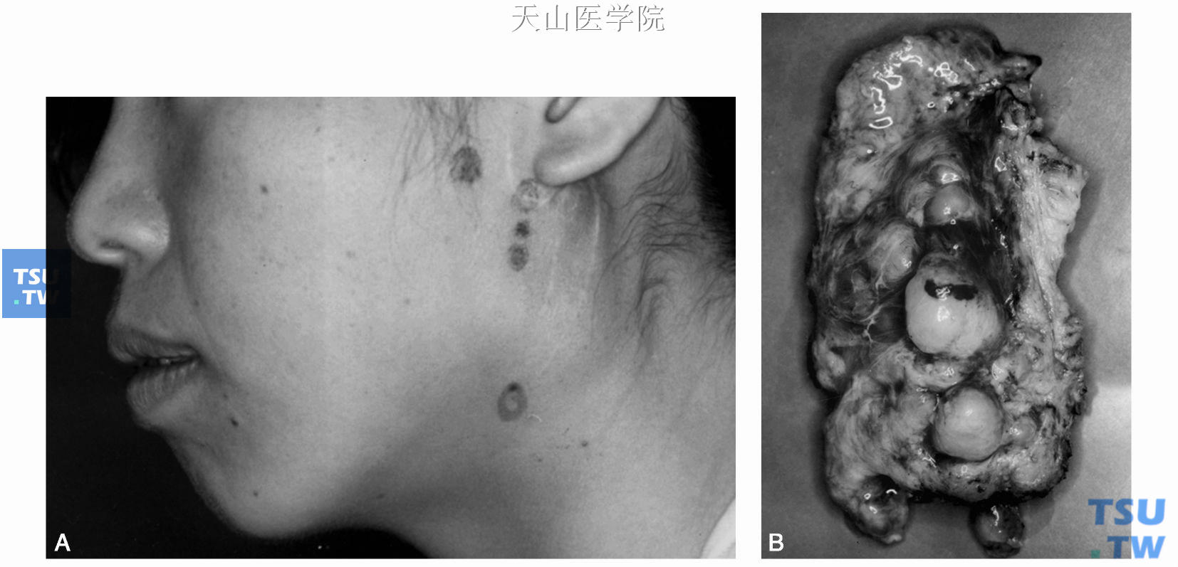 复发性多形性腺瘤：A.临床表现；B.术后标本显示多个结节