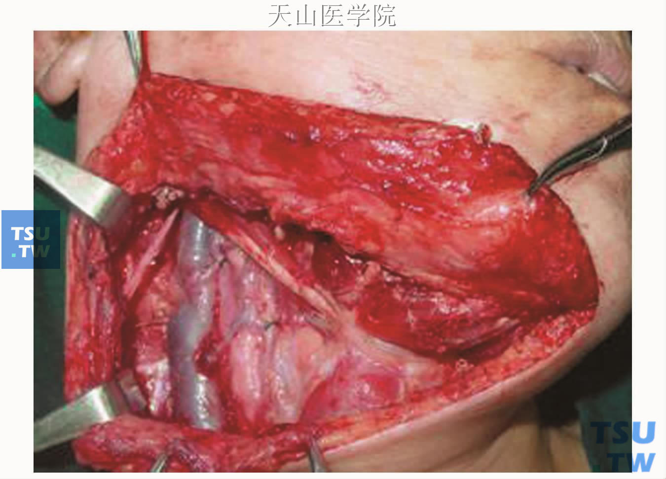 唾液腺癌颈淋巴清除术的手术步骤