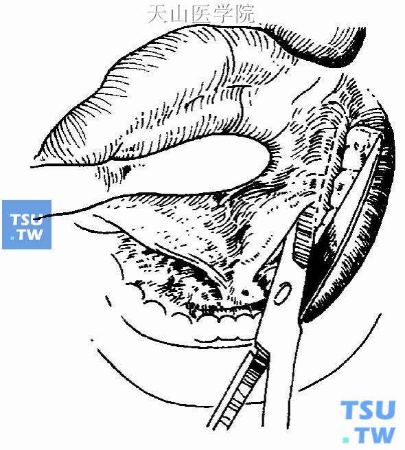 舌下腺切除术