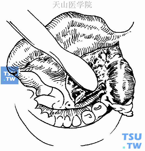 下颌下腺导管及舌神经的关系