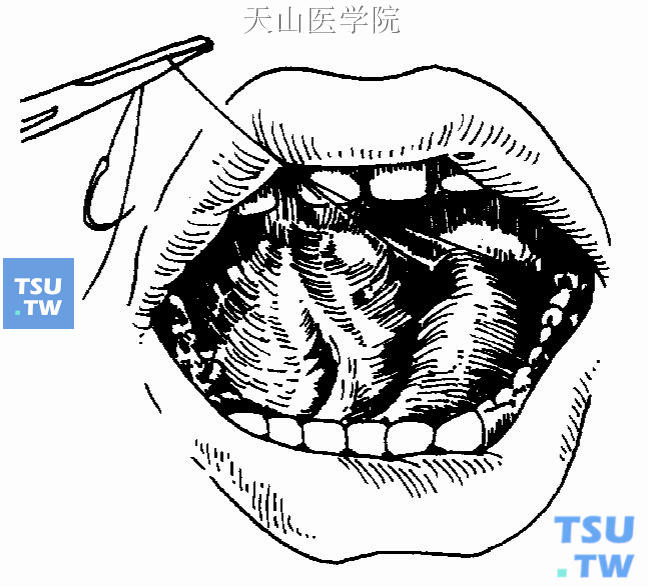 缝线牵引固定下颌下腺导管结石