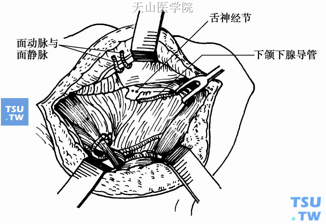 下颌下腺切除后创面