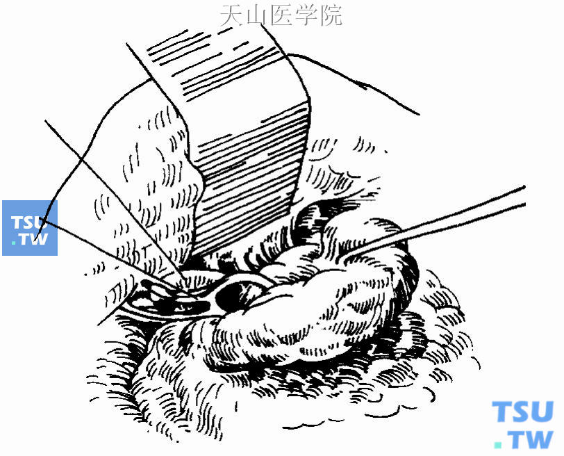 分离浅叶前缘、显露面神经