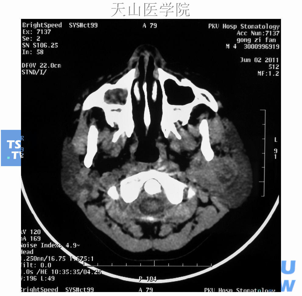 CT显示肿瘤位于下颌后窝，估计可以从此处摘除