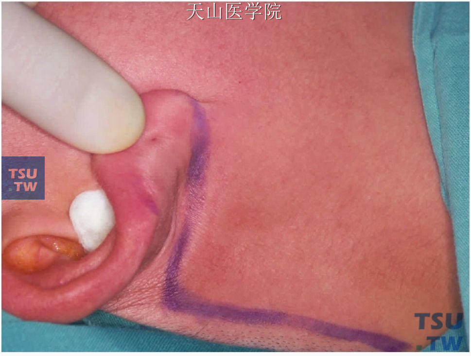 腮腺导管口红点图片