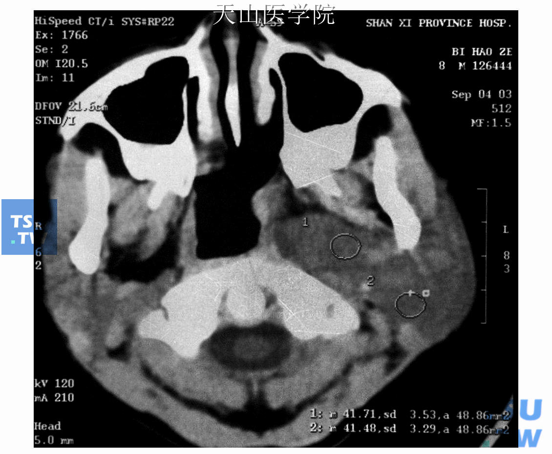 CT示肿瘤位于腮腺深叶