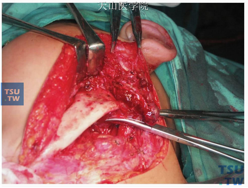 下颌下切口，下颌骨内侧显露瘤体，未解剖面神经