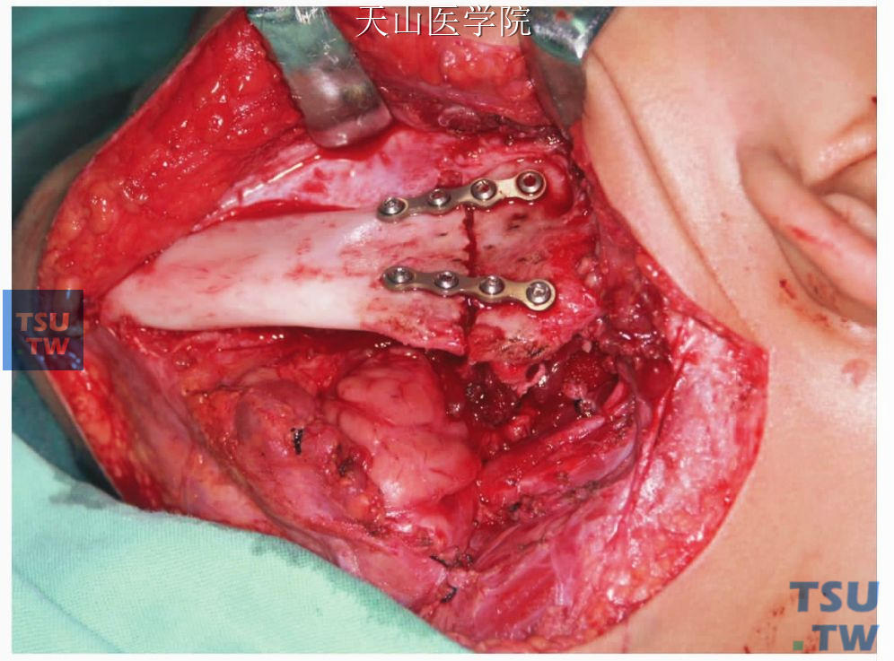 摘除肿瘤，复位下颌骨并固定