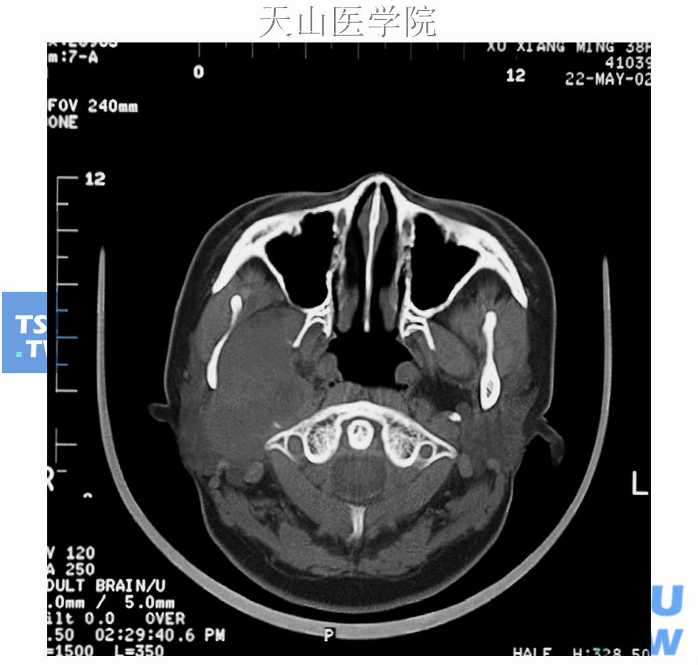 深叶肿瘤累及咽旁颞下区