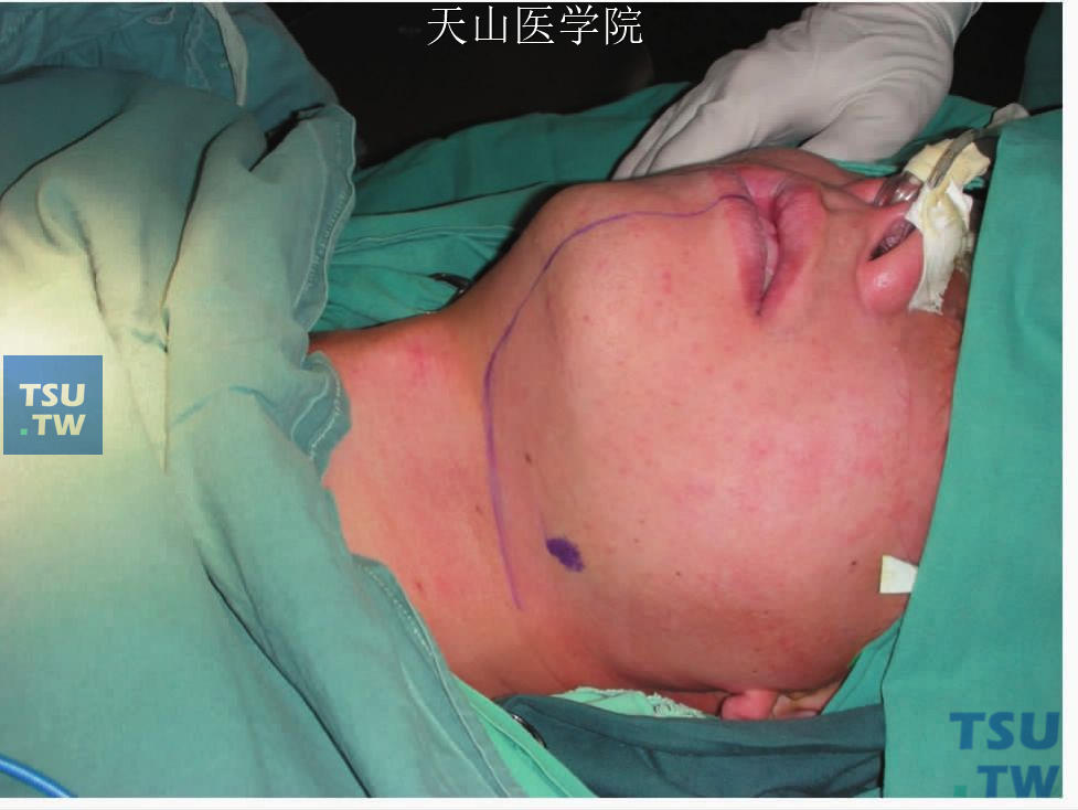 腮腺囊肿手术过程图图片