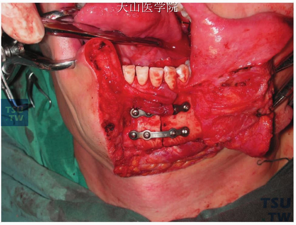用预置的钛板复位固定断离的下颌骨