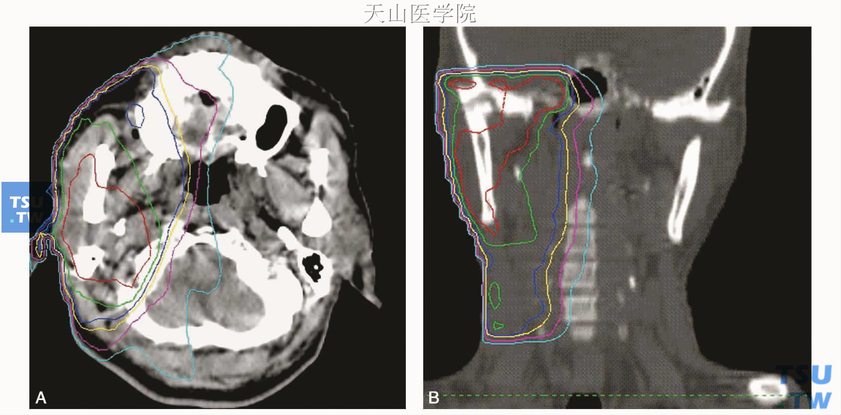 右侧腮腺腺样囊性癌术后调强放疗剂量分布图