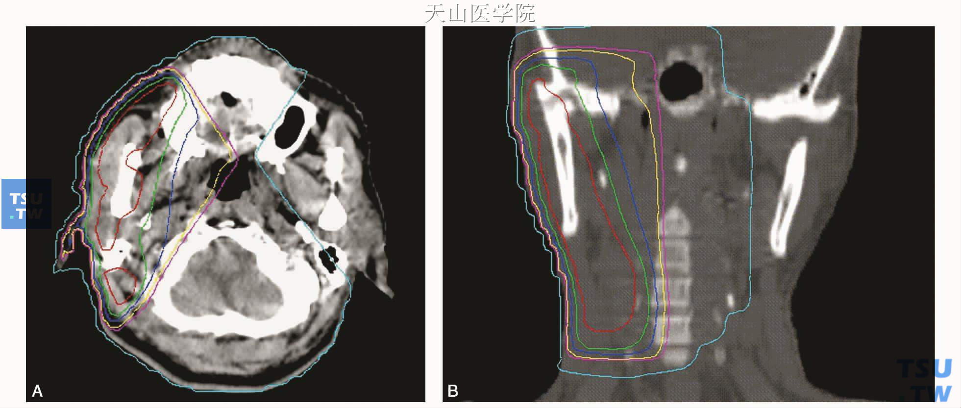 同图19-1　患者的术后常规放疗剂量分布图