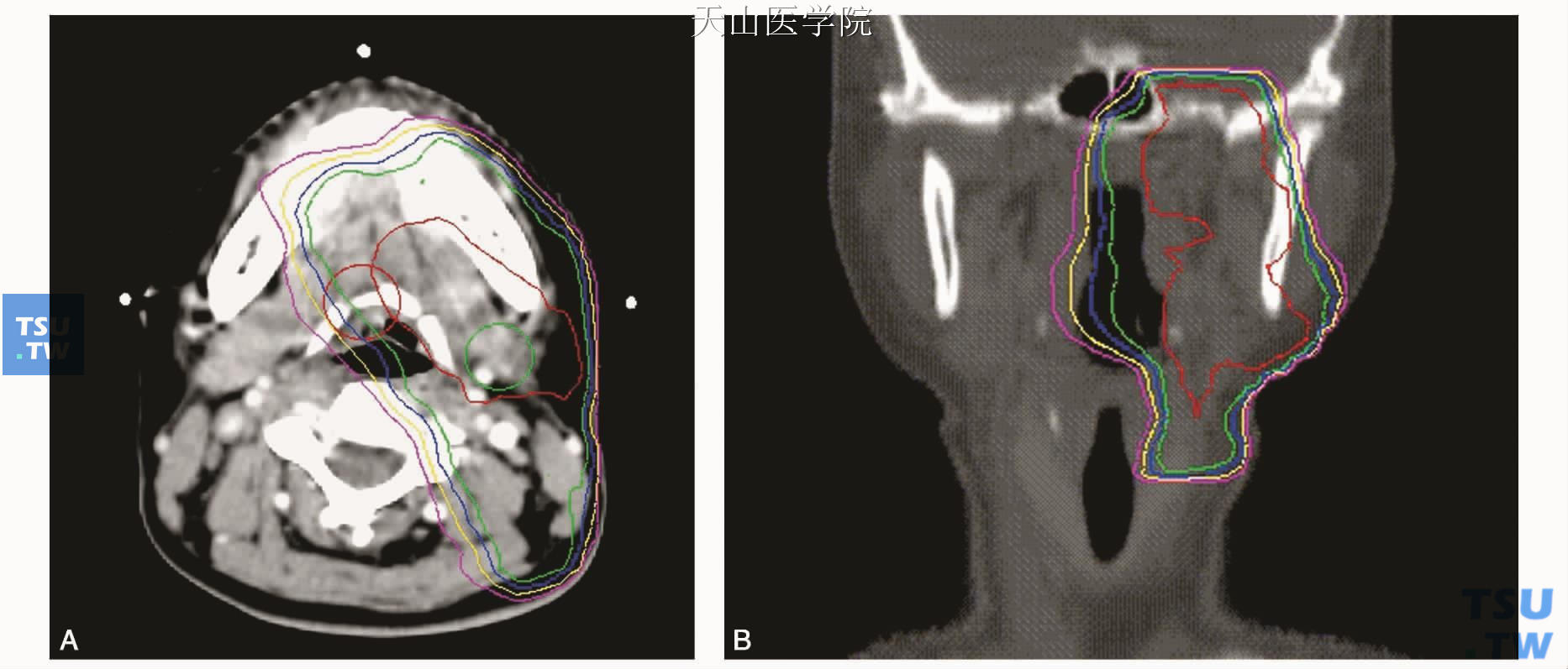 左侧下颌下腺腺样囊性癌（过中线）术后调强放疗剂量分布图