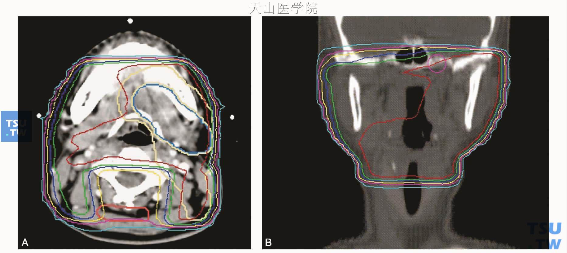 患者的术后常规放疗剂量分布图