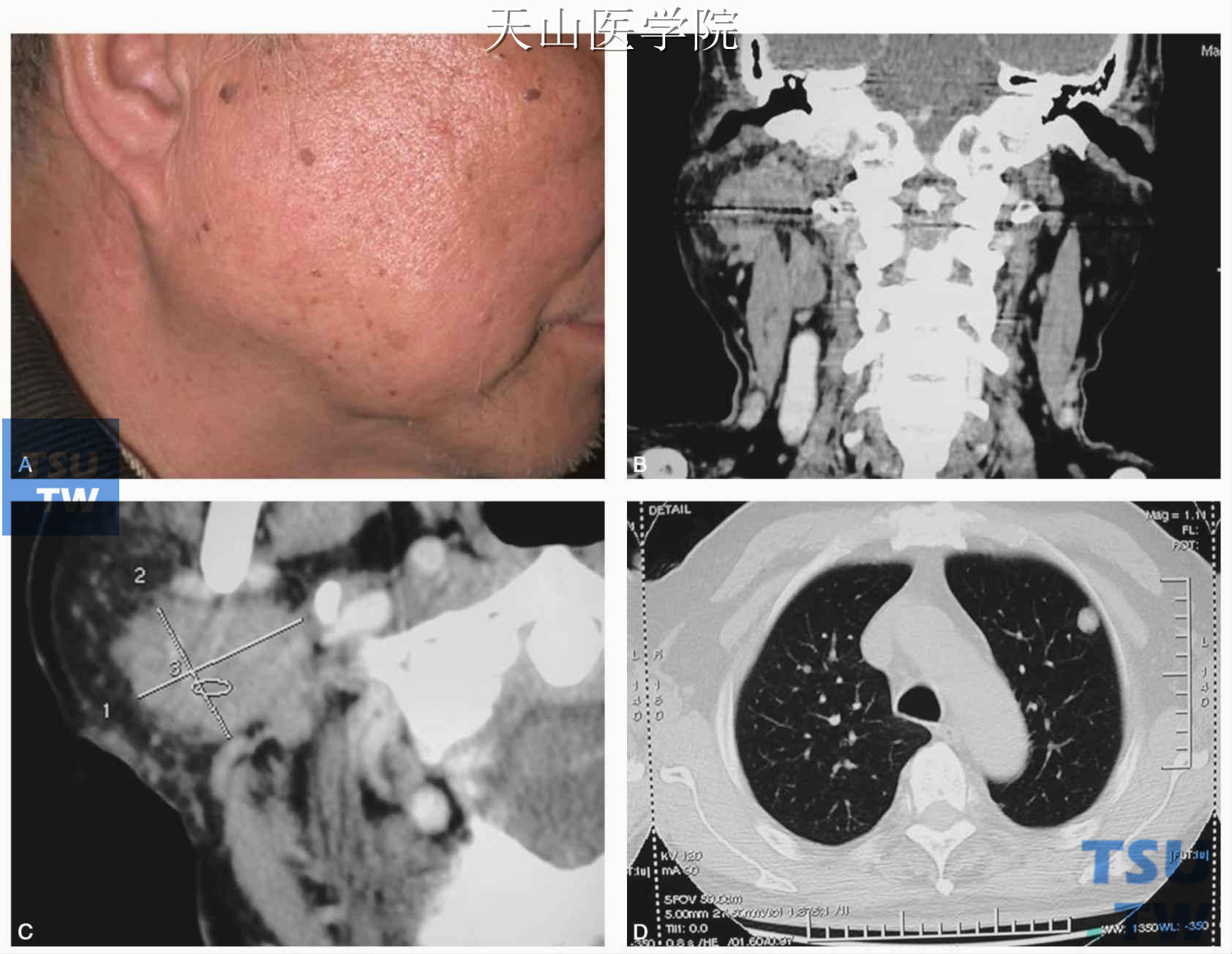 右腮腺癌治疗前：A.右侧腮腺肿块；B、C. CT显示右腮腺不规则高密度团块；D. CT显示肺部转移灶