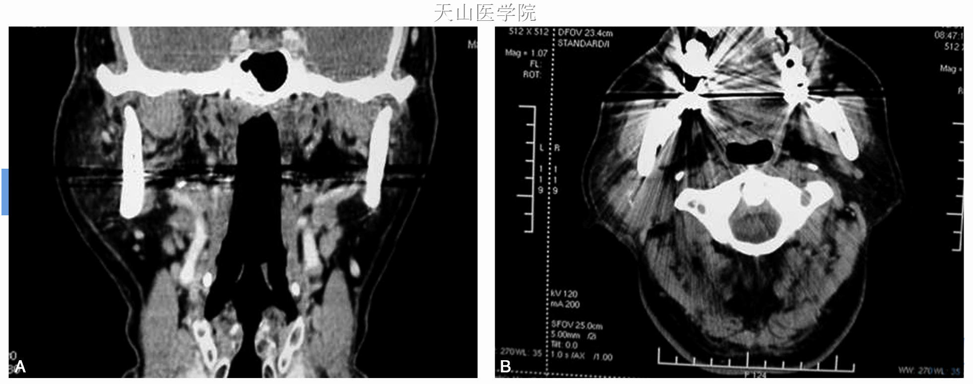 A、B. CT显示右腮腺肿块明显缩小