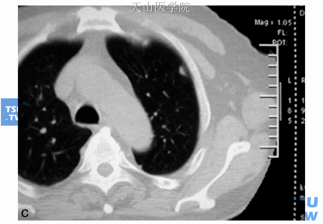 同一患者治疗后：A、B. CT显示右腮腺肿块明显缩小；C. CT显示肺部转移灶明显缩小