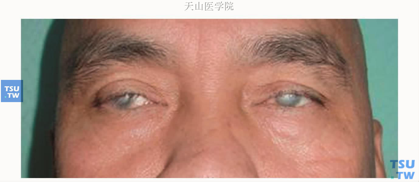 重症角结膜干燥症患者，眼表干燥，角膜混浊