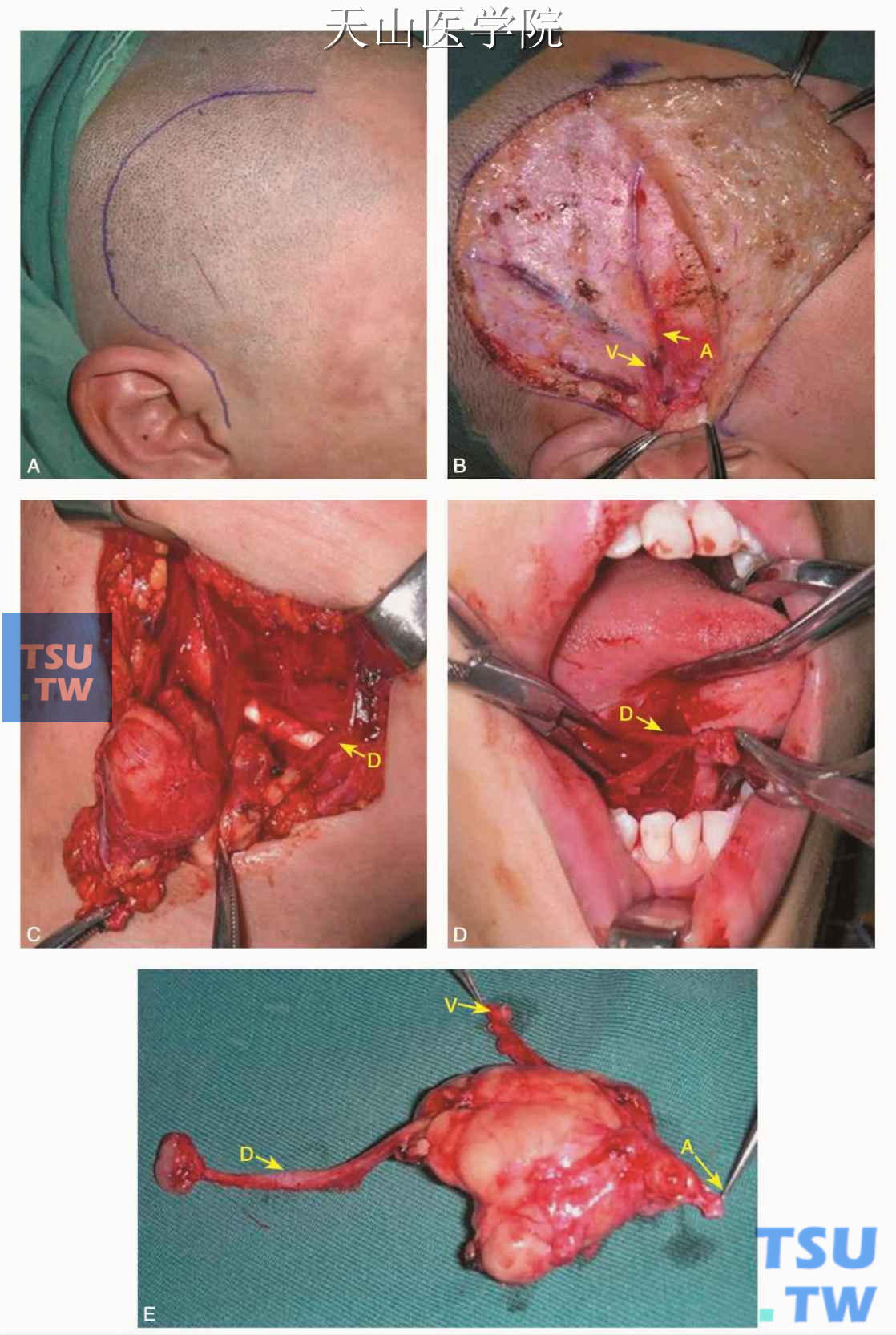 血管化自体下颌下腺移植手术过程