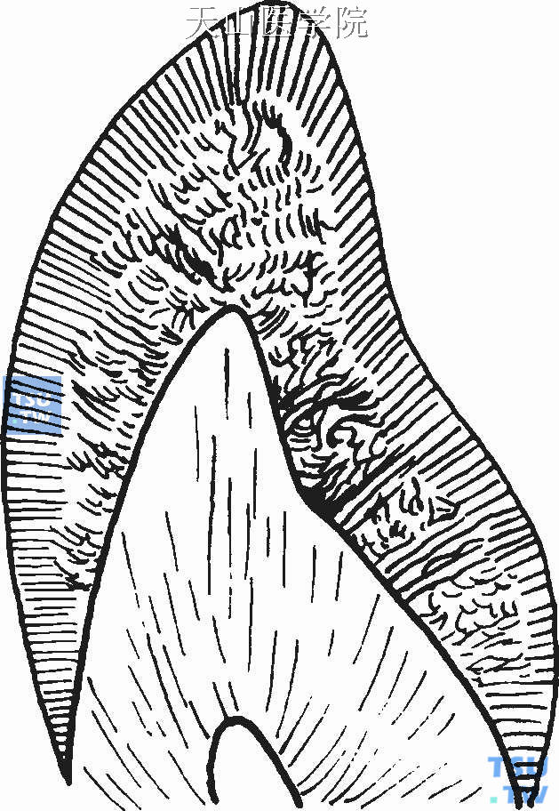 牙釉质釉柱图片