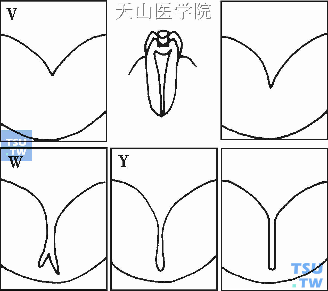 点隙裂沟形态