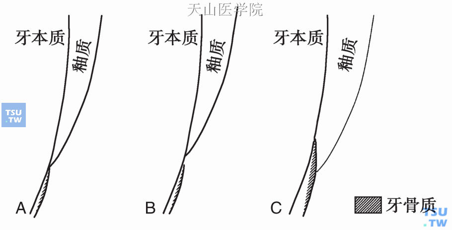 牙釉骨与牙骨质的连接；A．对接;B．未接;C．釉质覆盖牙骨质