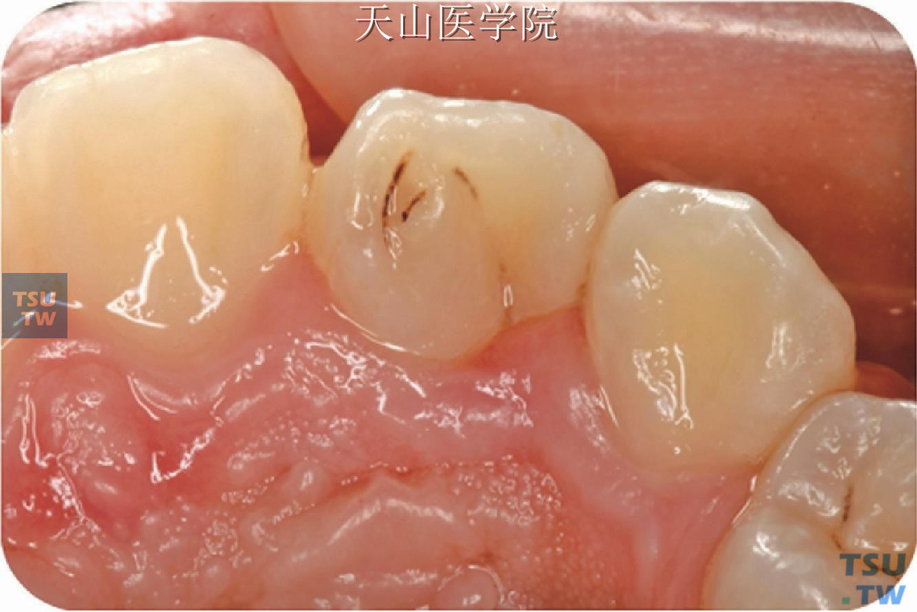 显微根尖手术联合活髓保存术治疗阻生牙所致的下颌第二磨牙牙根外吸收