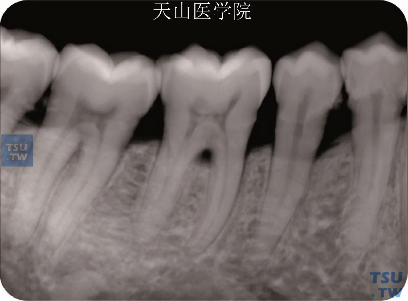 下颌第一磨牙指向颊侧的沟状根尖，X线片上不明显