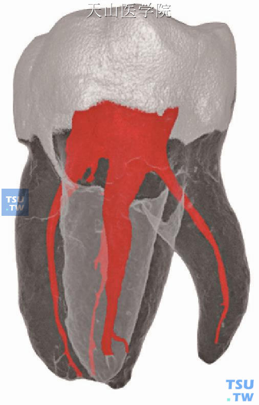 下颌第一磨牙指向颊侧的沟状根尖，X线片上不明显