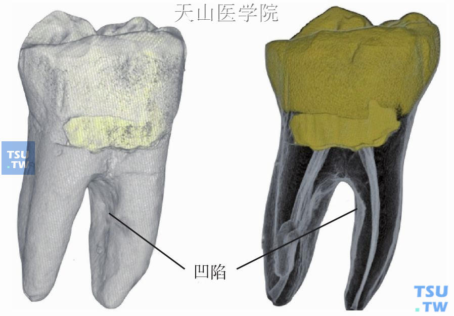 下颌磨牙　近中根远中面的凹陷