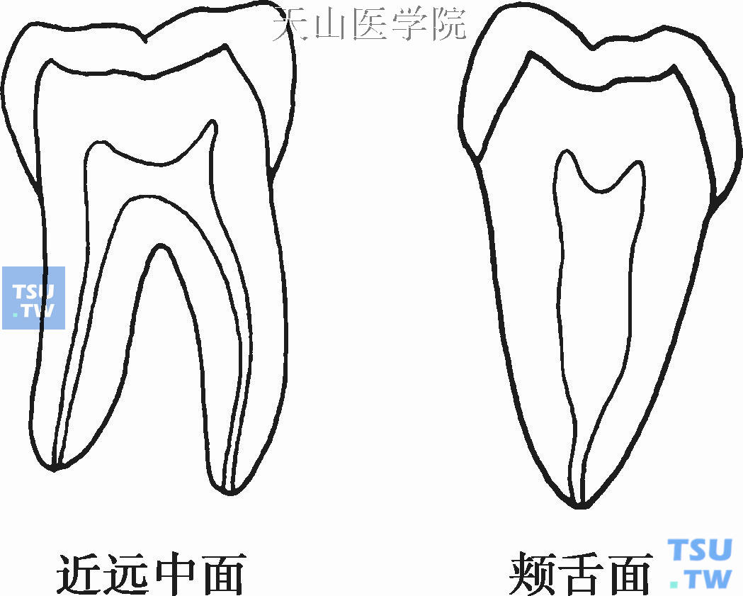 下颌磨牙髓腔形态