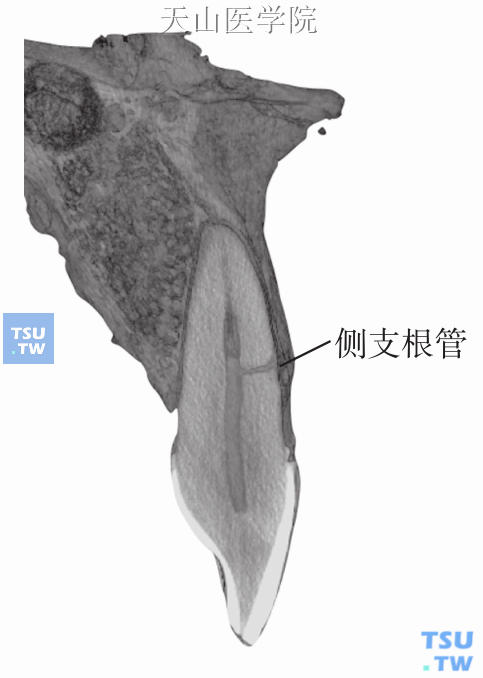 侧支根管