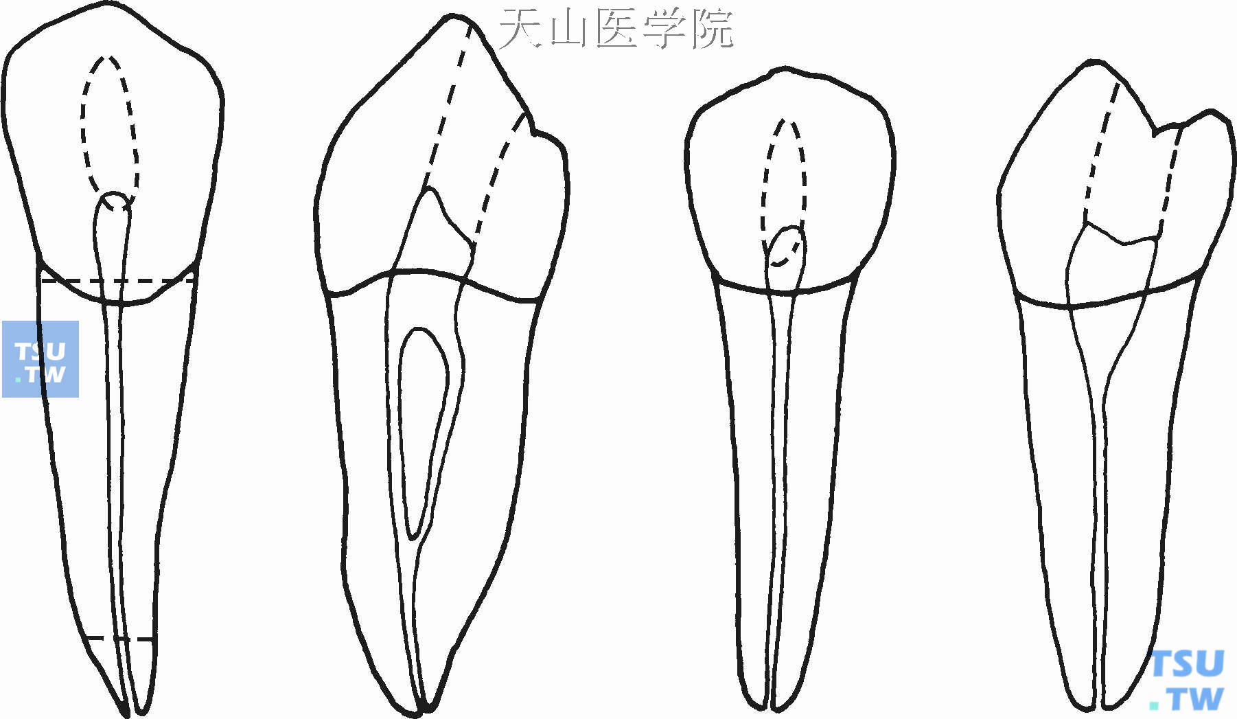 下颌前磨牙的根管形态
