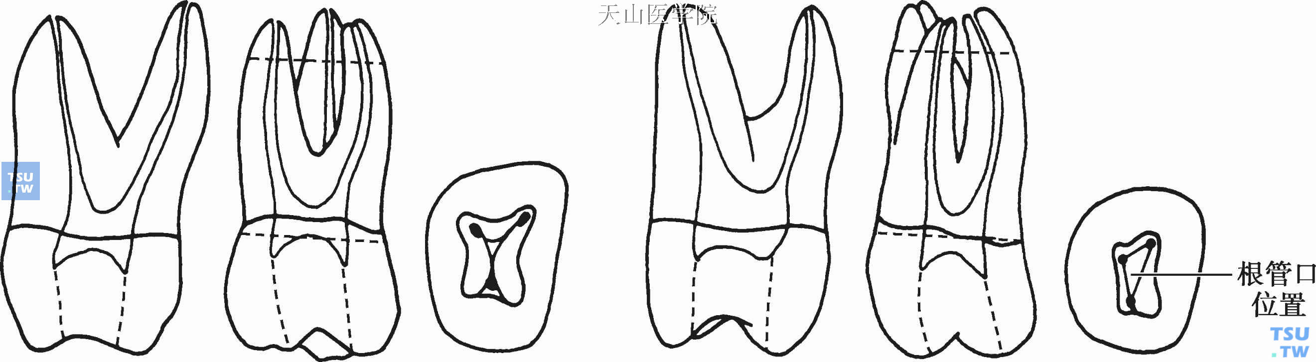 上颌磨牙根管形态及根管口位置