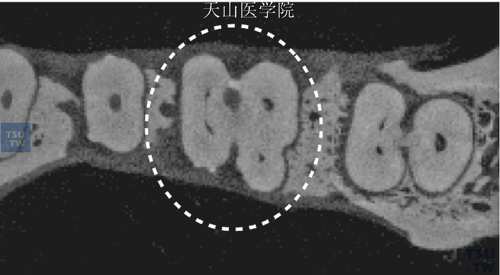 下颌第一磨牙4根管断面形态