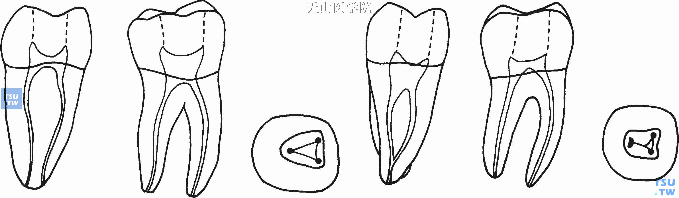 下颌磨牙根管形态及根管口位置