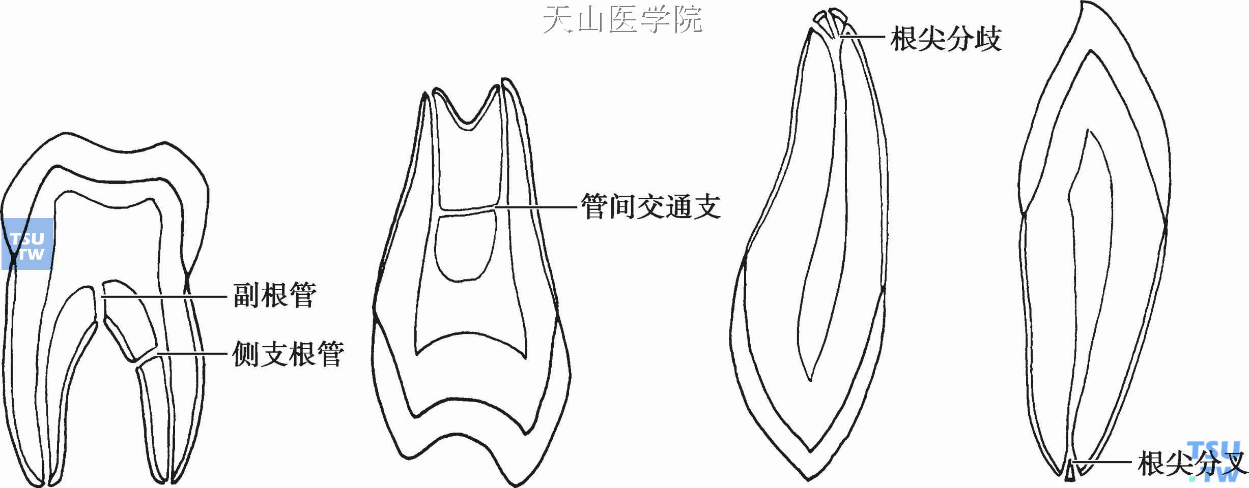 根管的特殊形态