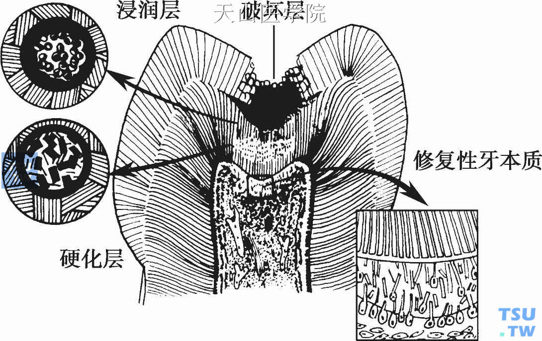 牙本质龋分层