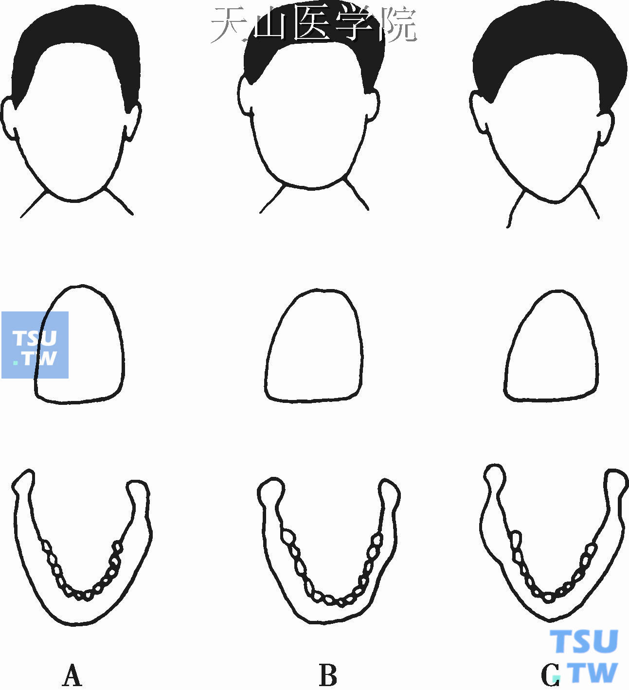 牙型、牙弓型与面型的协调关系：A．椭圆型;B．方圆型;C．尖圆型
