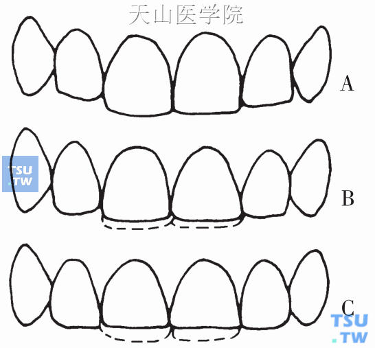 不同年龄阶段牙齿切端磨耗情况