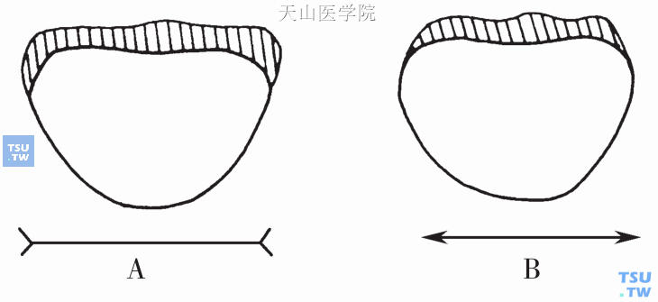 利用长短错觉原理使牙体“加宽”或“变窄”