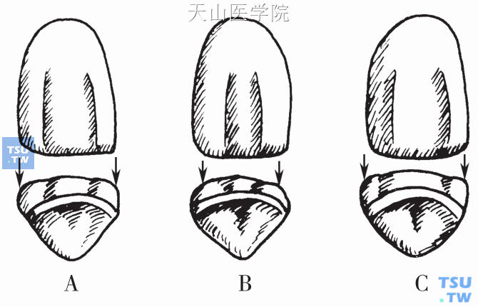 调整发育沟宽度“改变”唇面宽窄