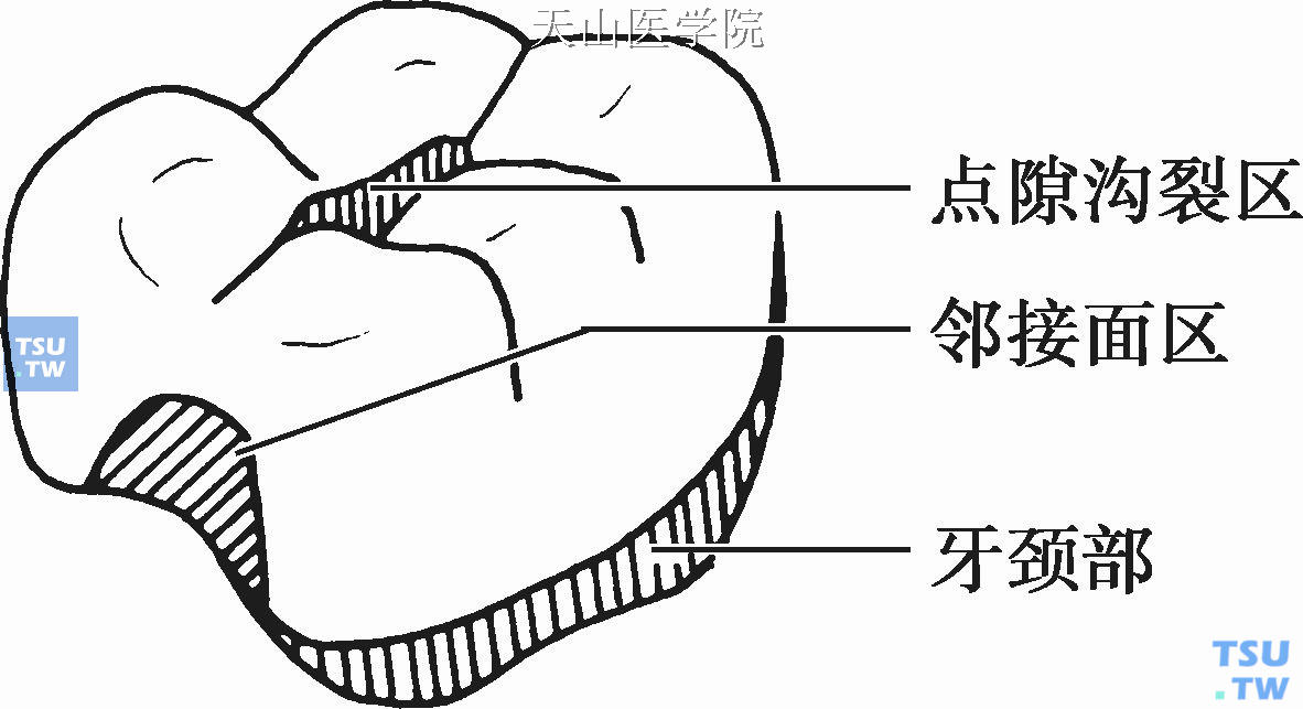 牙齿表面滞留区