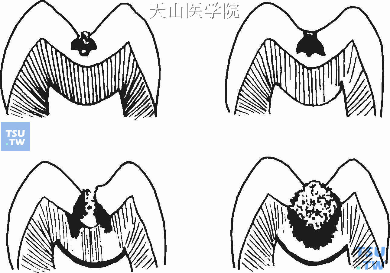 窝沟龋的发展过程