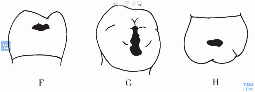 后牙邻面龋、Ⅱ类洞形