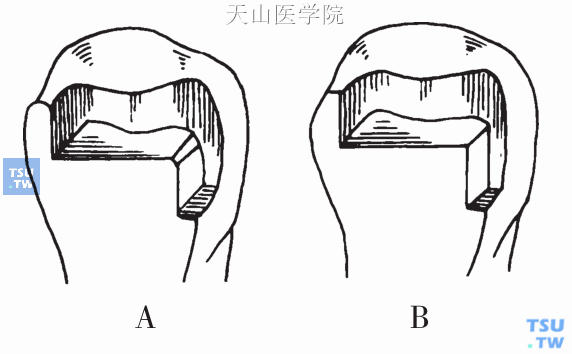 双面Ⅱ类洞剖面结构，示梯形线角