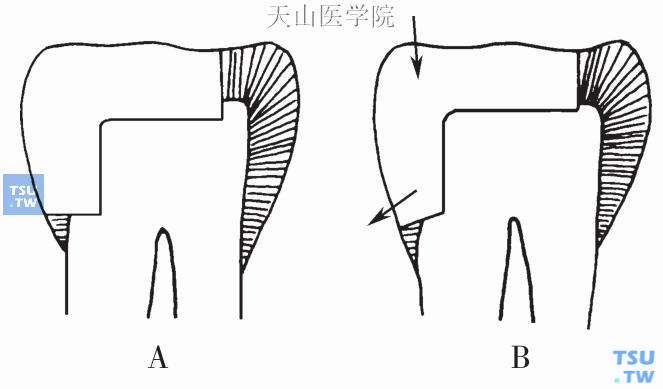 邻 洞剖面结构，示龈壁