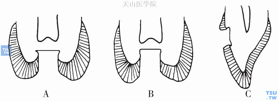 倒凹固位形